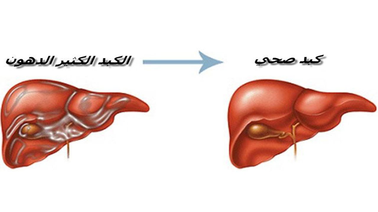 دهون الكبد وعلاجها 7867 2