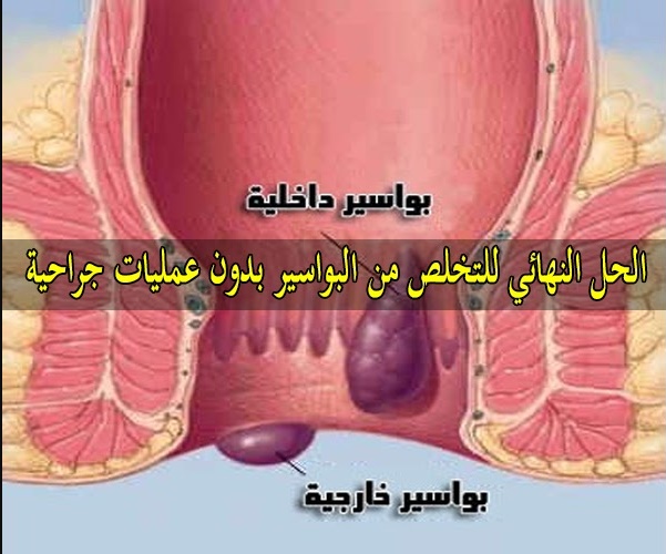 علاج البواسير , الثلج فى علاج البواسير