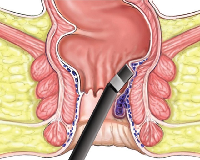 التخلص من البواسير , علاج نهائي لمرض البواسير