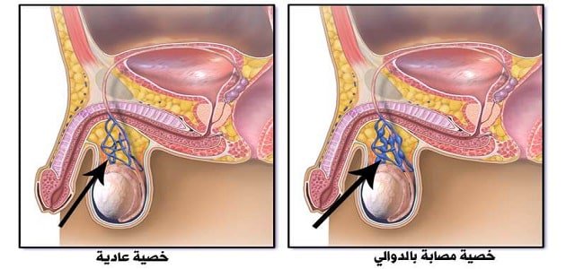 علاج دوالى الخصية , مشاكل دوالي الخصيتين واساليب علاجها