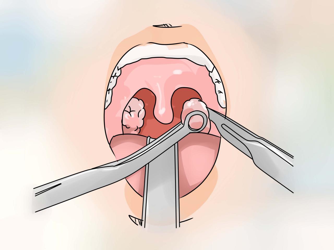 ماهي اعراض اللوز - يجب شرب سوائل كثيرة 9909