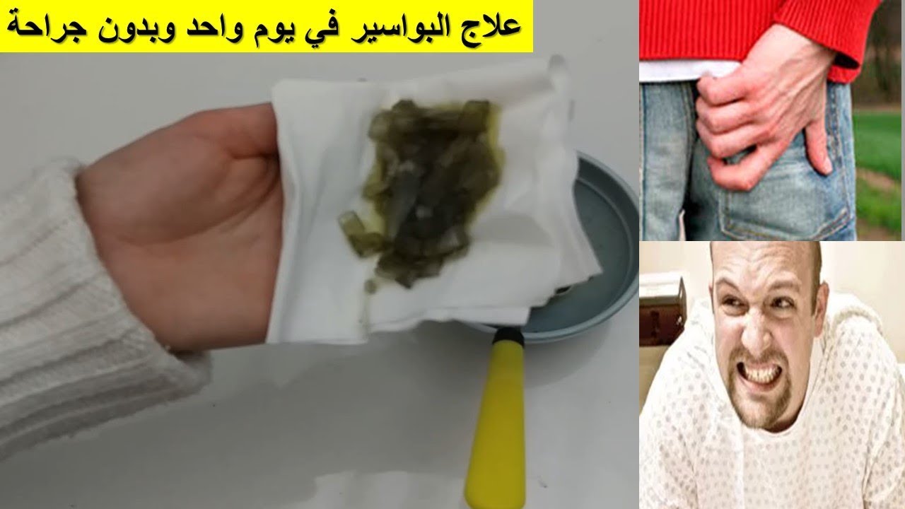 علاج البواسير في يوم واحد , وصفات طبيعية و امنة تعمل على علاج البواسير