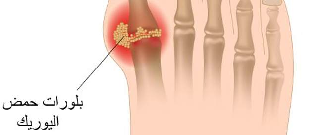 مرض النقرس-ماهي اعراض النقرس 9959 3