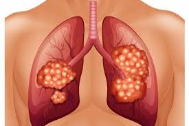 اعراض مرض السرطان , اعراض سرطان الرئه وعلاجة