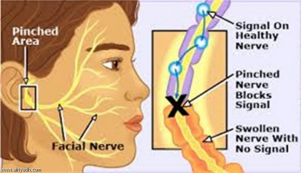 اعراض العصب السادس - العامل النفسي وعلاقته بالعصب السابع 11189 9