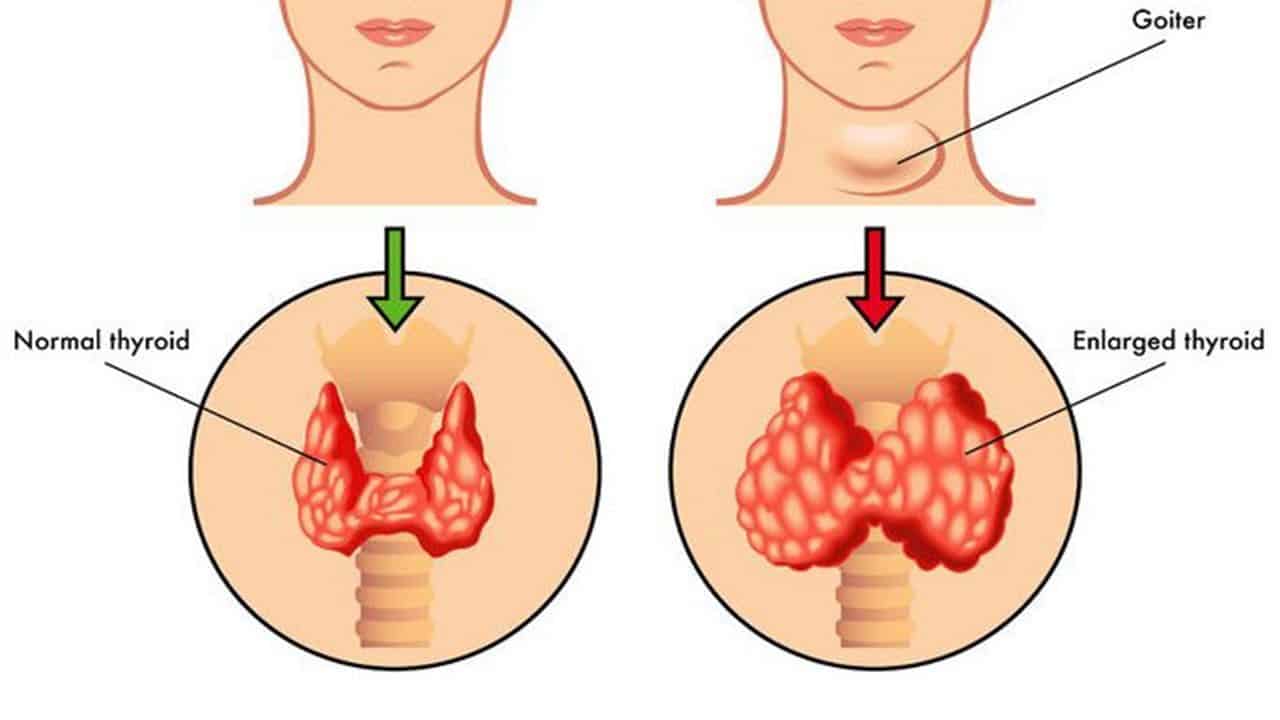 علاج نشاط الغدة الدرقية , الطرق المستخدمة لعلاج الغدة في حالة النشاط المفرط