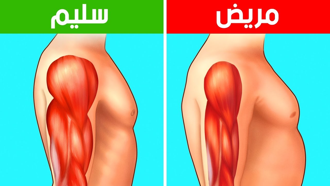 اسباب ضمور العضلات - التغذية غير صحيحة وقلة الحركة 9574