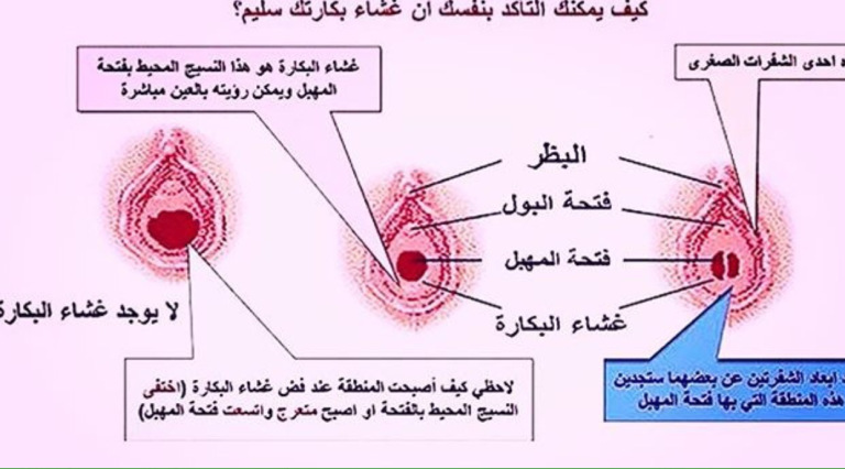 غشاء البكارة , عملية ترقيع غشاء بكارة