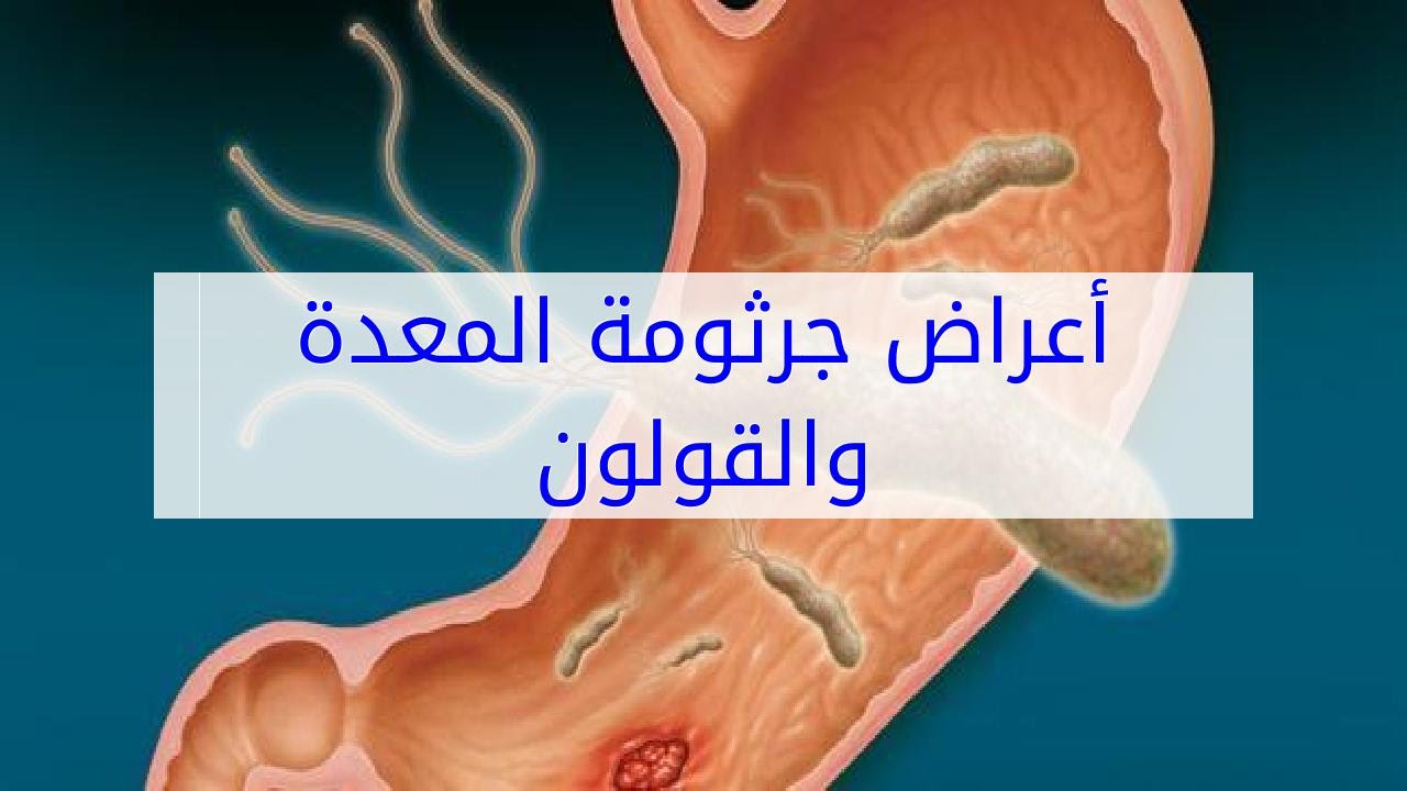 اعراض جرثومة المعده والقولون 8282 2