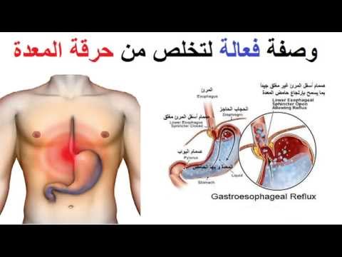 ما علاج حرقة المعدة , حرقة المعدة وطرق حلها