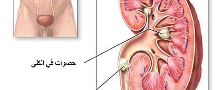 علاج حصى الكلى بالاعشاب , طرق طبية لمعالجة حصوات الكلي بالاعشاب