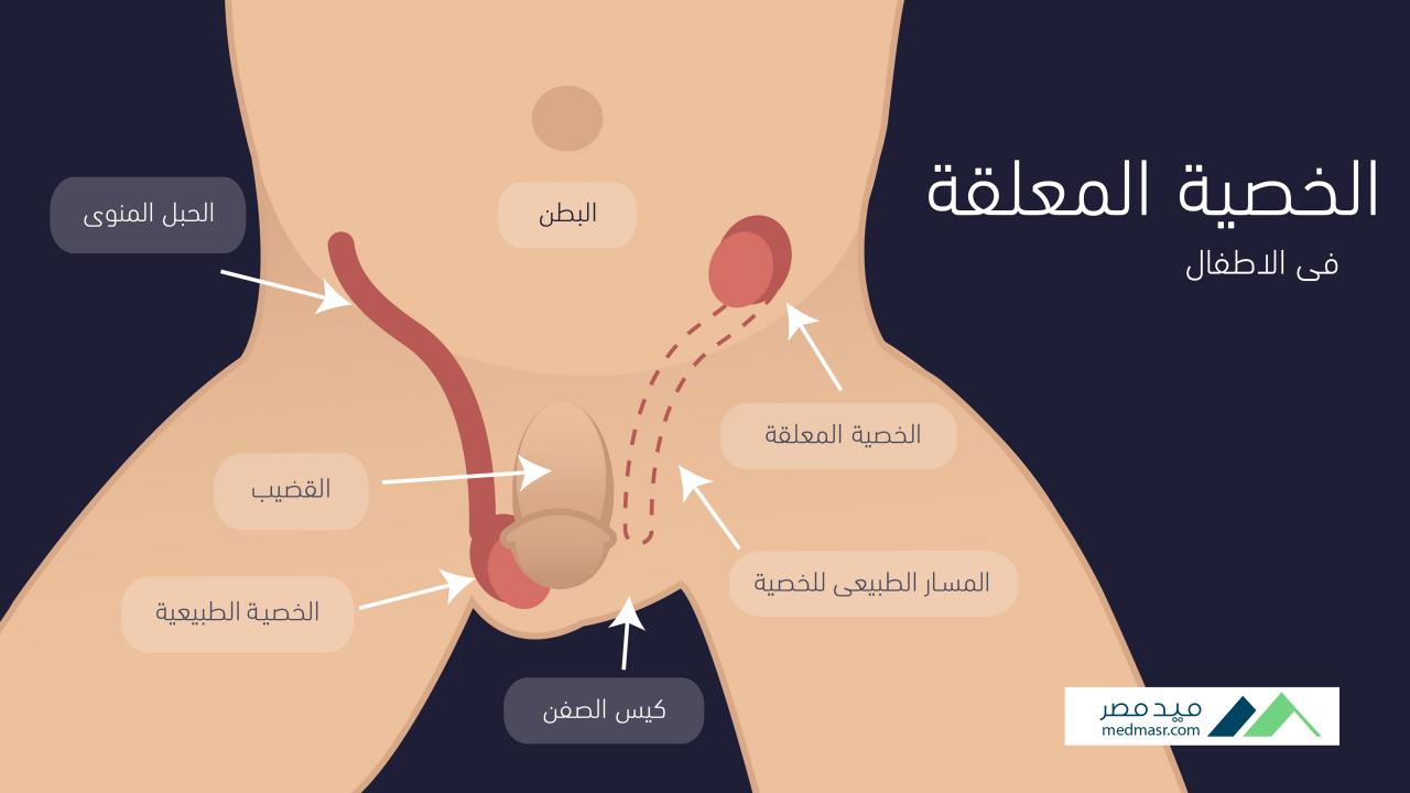 اضرار الخصية الواحدة 8077