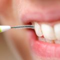 8447 2 نصائح بعد تنظيف الاسنان من الجير - افضل الوسائل للحفاظ على الاسنان بعد الجير حبيبي